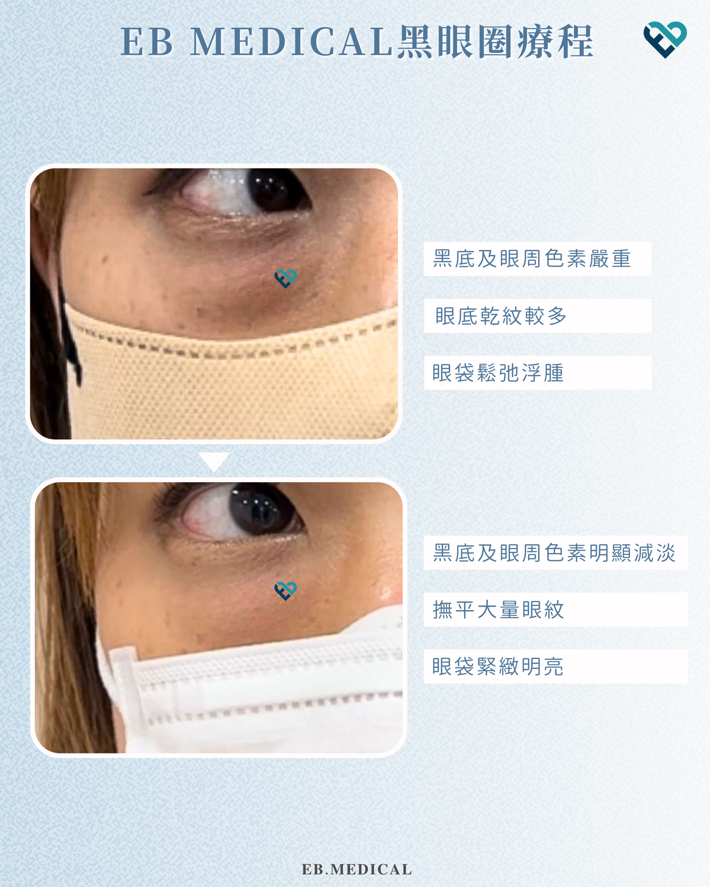 【水光針】REJURAN白盒