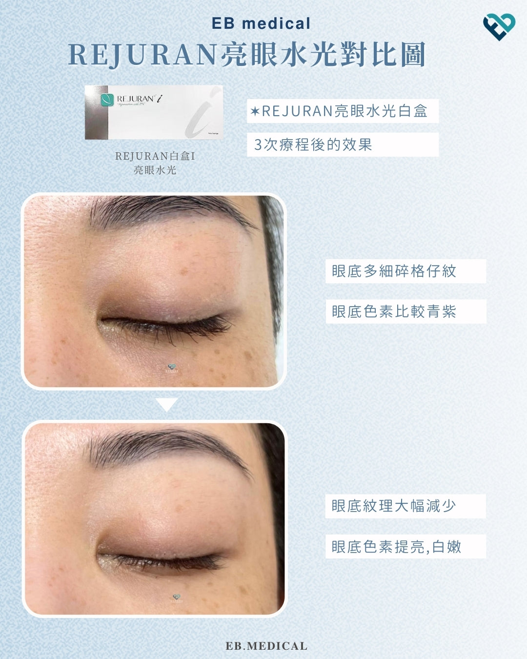 【水光針】REJURAN白盒