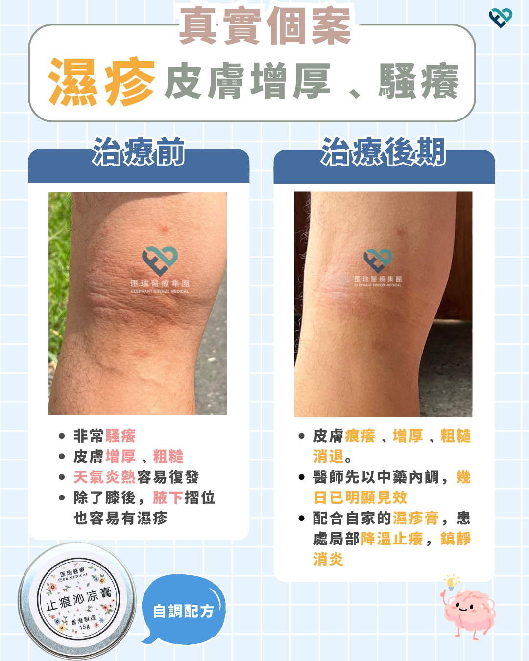 濕疹