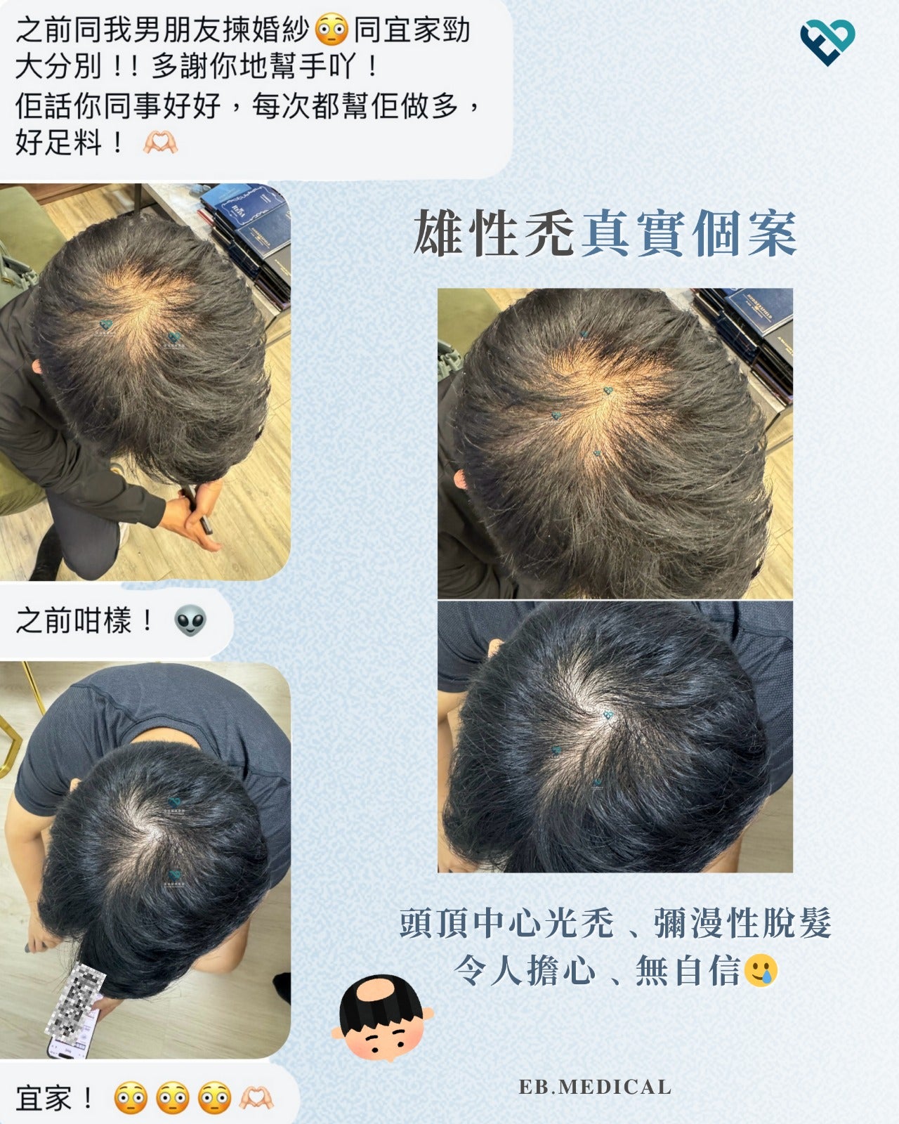 爆髮療程