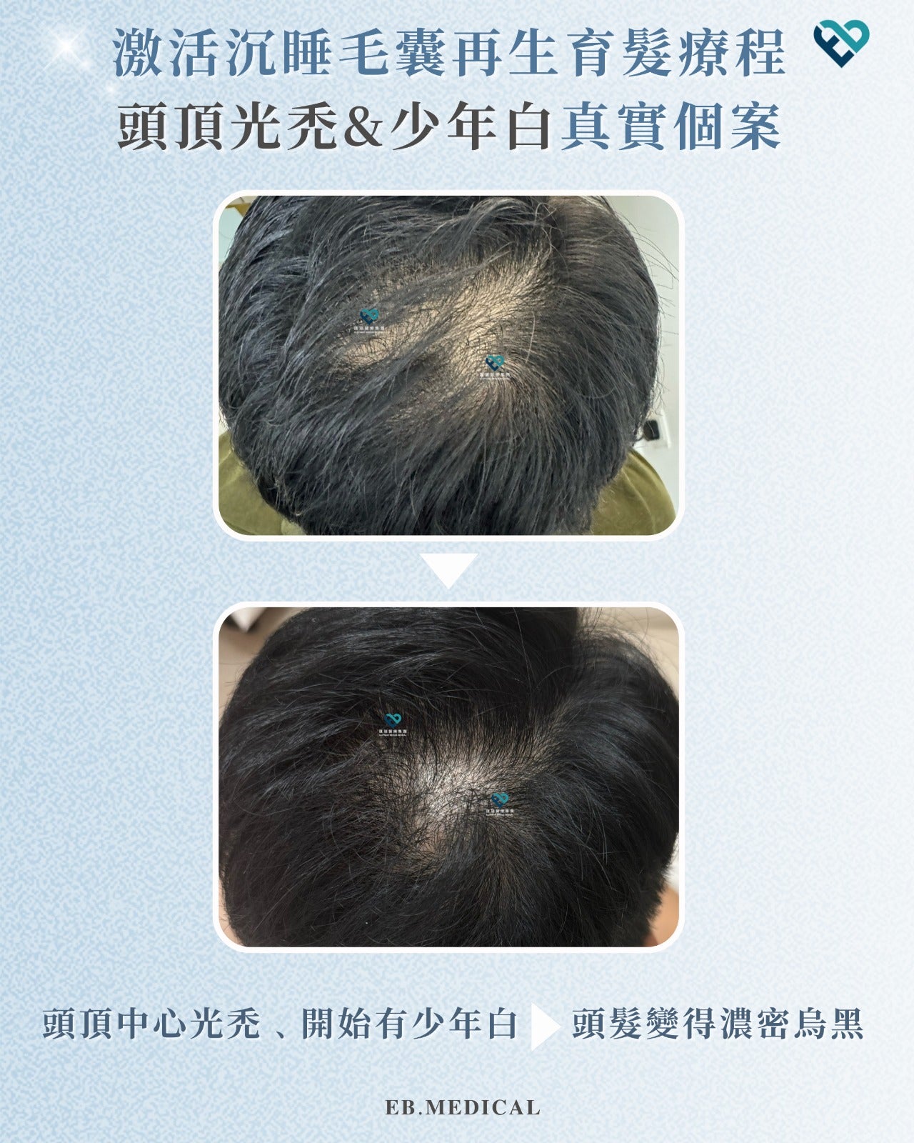 爆髮療程